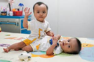 Phẫu thuật thành công mổ tách cặp song sinh dính liền